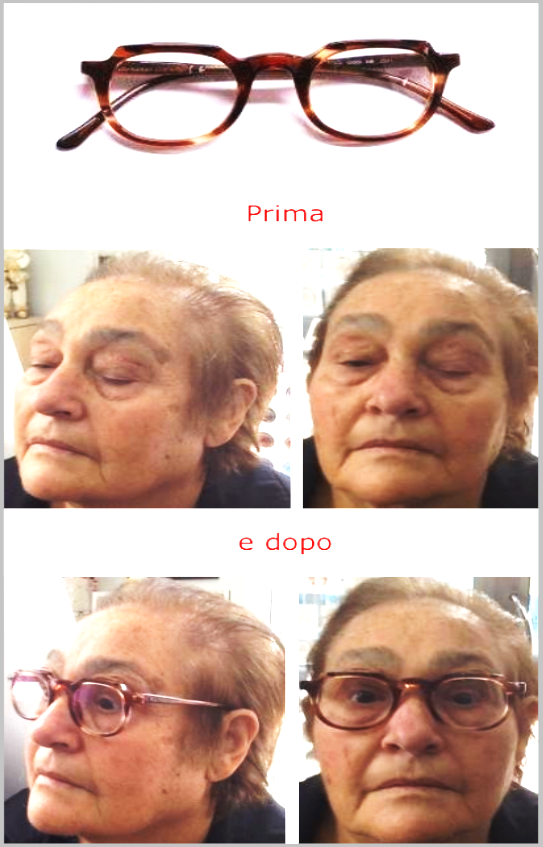 94241817_Ptosi_-_Copia.png